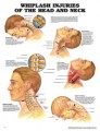 Whiplash Injuries of the Head and Neck Poster