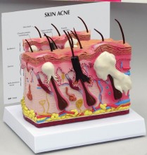 Acne Skin Model
