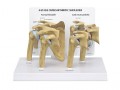 Shoulder Osteoarthritis Anatomical Model
