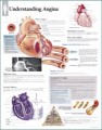 Understanding Angina Anatomical Poster