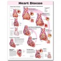 Heart Disease Anatomical Chart, 2nd Edition