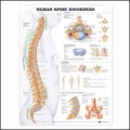 Spine Disorders Anatomical Chart - Human