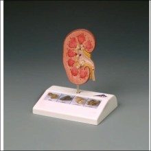 Kidney Stone Anatomical Model