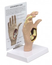 Hand Osteoarthritis Anatomical Model