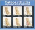 Osteoarthritis Poster