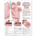 Chronic Obstructive Pulmonary Disease (COPD) Poster