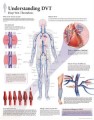 Deep Vein Thrombosis DVT Poster