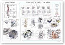 Spine Common Disorders Poster