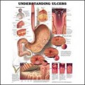 Understanding Ulcers Chart