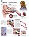Ear Anatomy Poster, Infections of the Middle Ear