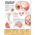 Stroke Poster (Entendiendo qué es un derrame)