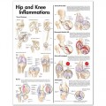 Hip and Knee Inflammations Anatomical Chart 2nd ed.