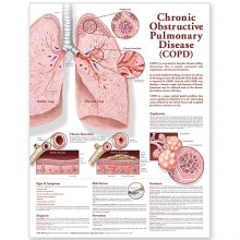Chronic Obstructive Pulmonary Disease (COPD) Poster