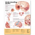 Stroke Anatomical Chart 2nd Edition