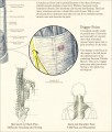 Myofascial Pain Syndrome Poster