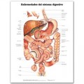 Diseases of the Digestive System (Enfermedades del sistema digestivo) Chart