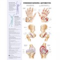 Understanding Arthritis Anatomical Chart