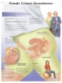 Female Urinary Incontinence