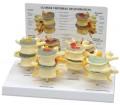Four Stage Vertebrae Model and Disc