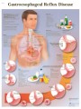 Gastroesophageal reflux disease Poster