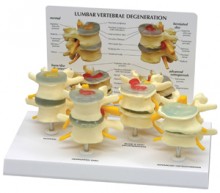 Four Stage Vertebrae Model and Disc