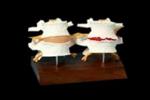 Vertebrae Normal/Degenerated