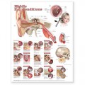Middle Ear Conditions Anatomy Poster