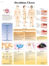Decubitus Ulcers Chart