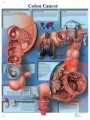 Colon Cancer Poster