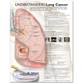 Understanding Lung Cancer Anatomical Chart