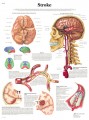 Stroke Chart