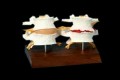 Vertebrae Normal/Degenerated
