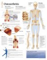 Osteoarthritis Poster