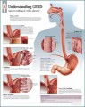 Understanding GERD (gastroesophageal reflux disease) Anatomical Chart