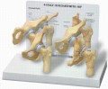 Arthritic Hip ,4-Stage