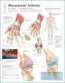 Rheumatoid Arthritis Poster