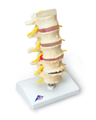 Stages of disc prolapse and vertebral degeneration Model